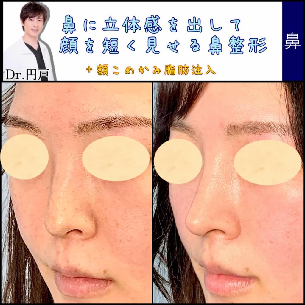 鼻尖形成と鼻中隔延長と脂肪注入の症例写真 (1)