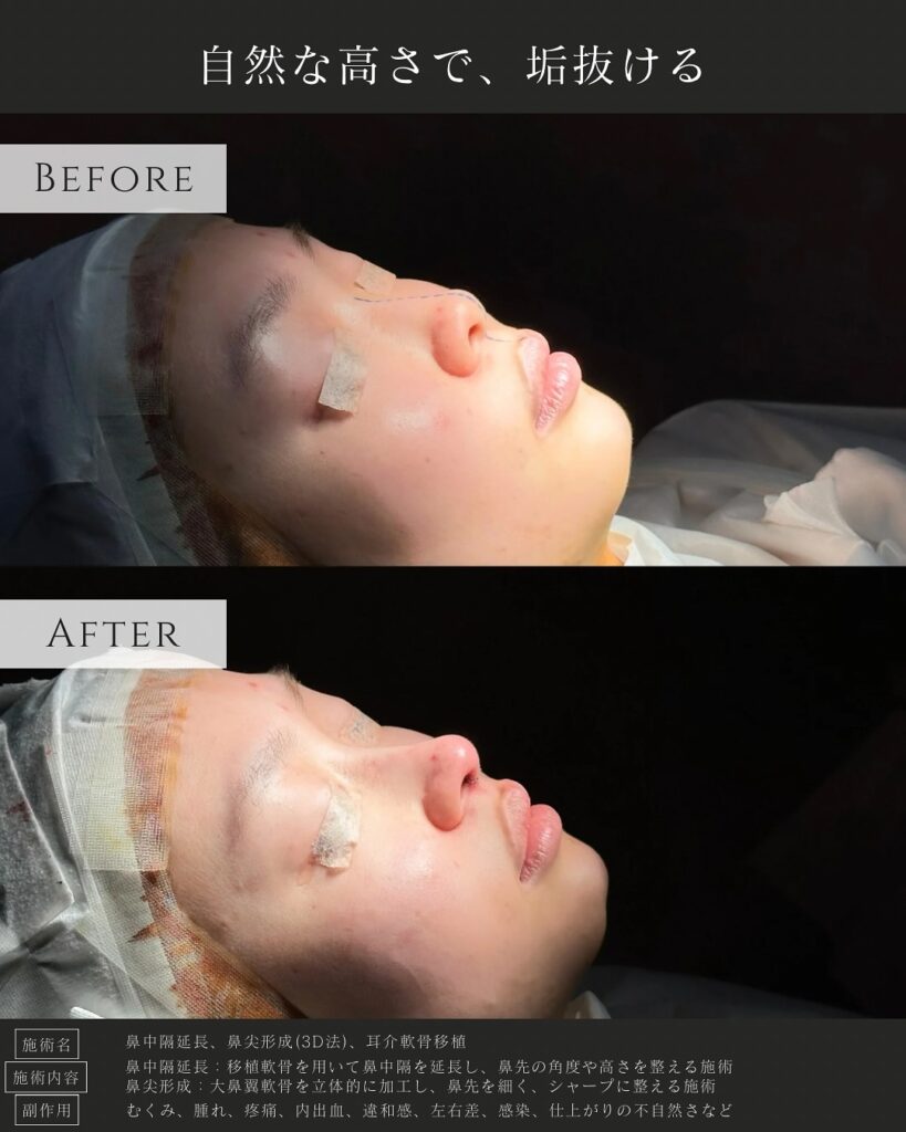 鼻中隔延長と鼻尖形成と耳介軟骨移植の症例写真 (3)