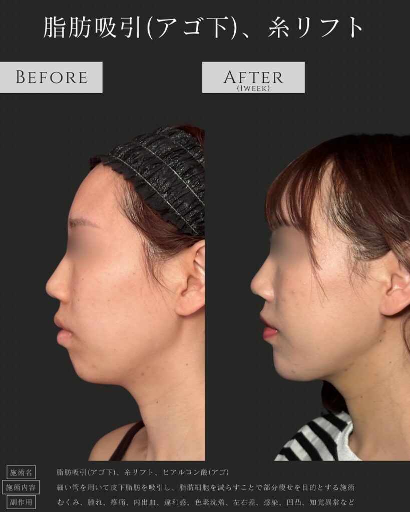 顎下の脂肪吸引と糸リフトと顎のヒアルロン酸の症例写真 (1)