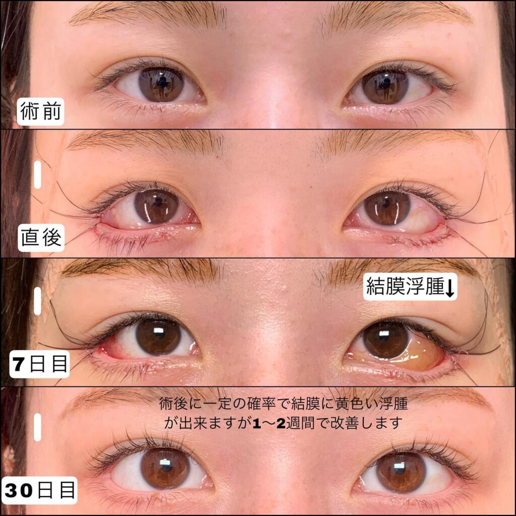 目尻切開と下瞼拡大の症例写真 (3)