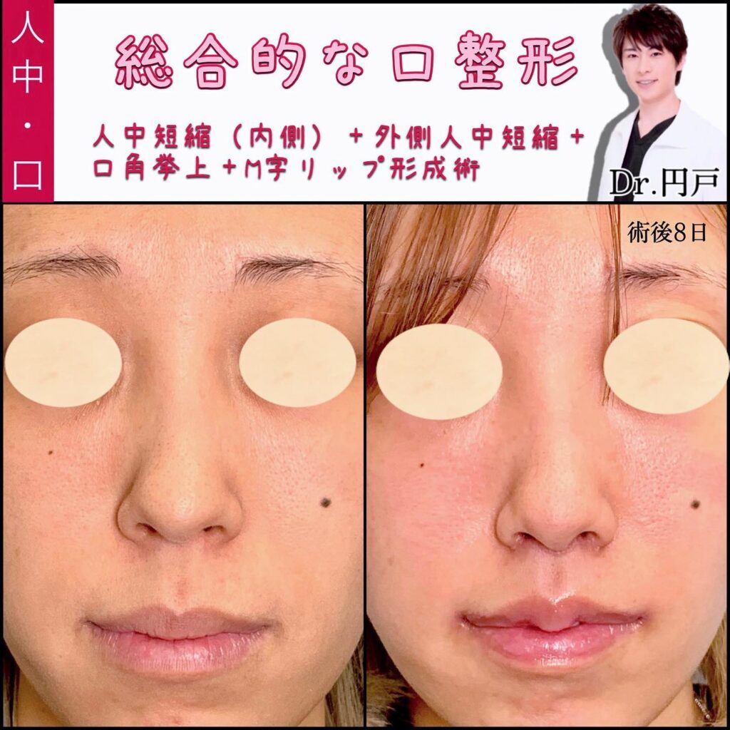 内側人中短縮と外側人中短縮と口角挙上とM字リップ形成を同時に行った症例写真