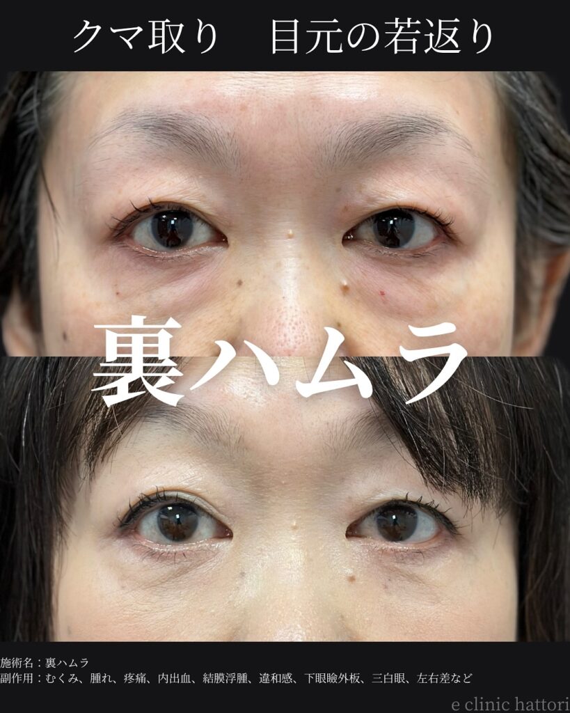 裏ハムラ法の症例写真 (53)