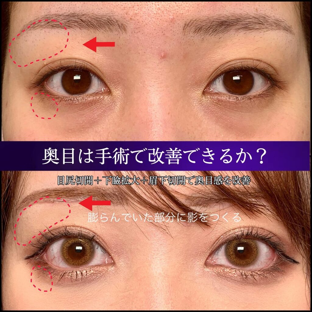 目尻切開と下瞼拡大と目尻切開の症例写真 (3)