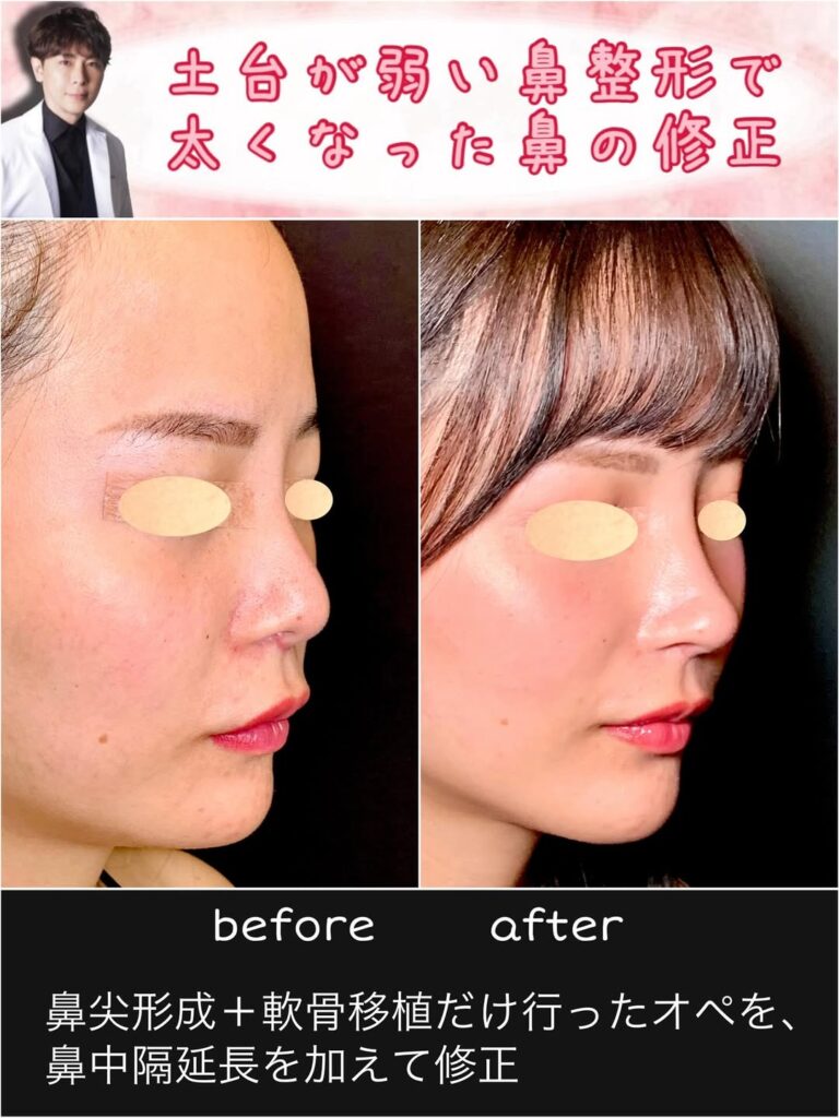 鼻尖形成と軟骨移植と鼻中隔延長の症例写真 (2)