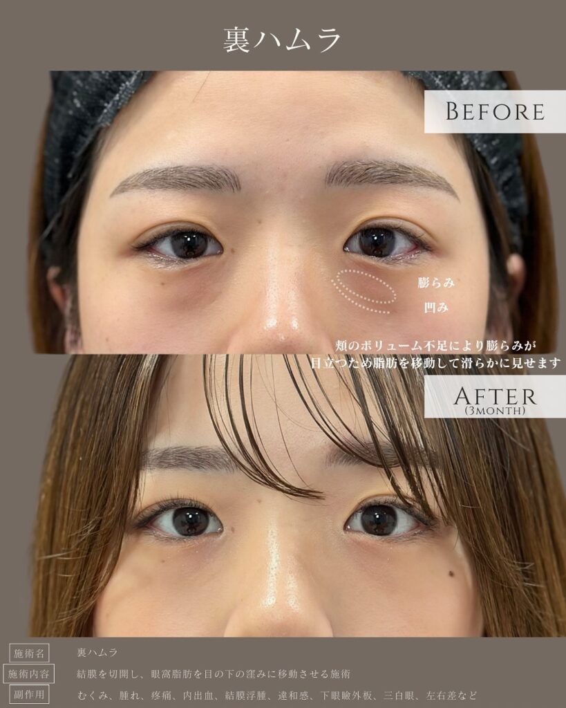 裏ハムラ法の症例写真 (19)