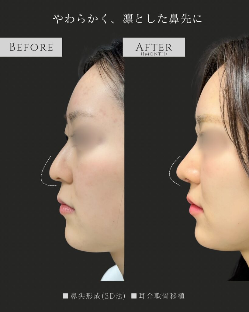 鼻尖形成と耳介軟骨移植の症例写真 (32)