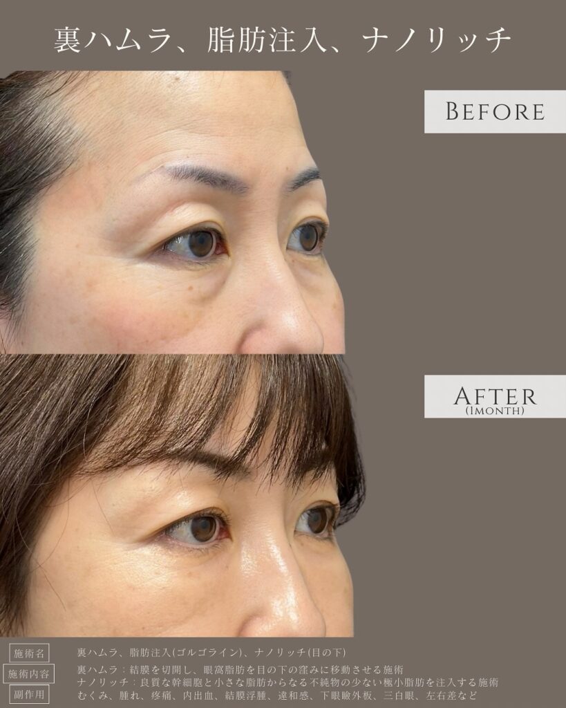 裏ハムラ法と目の下の脂肪注入の症例写真 (2)
