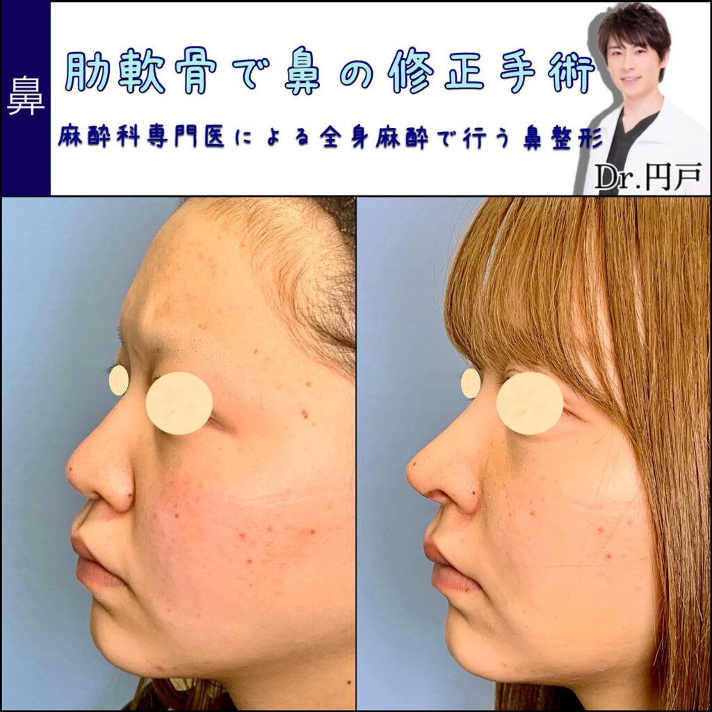 感染により肋軟骨移植で修正手術をした鼻中隔延長の症例