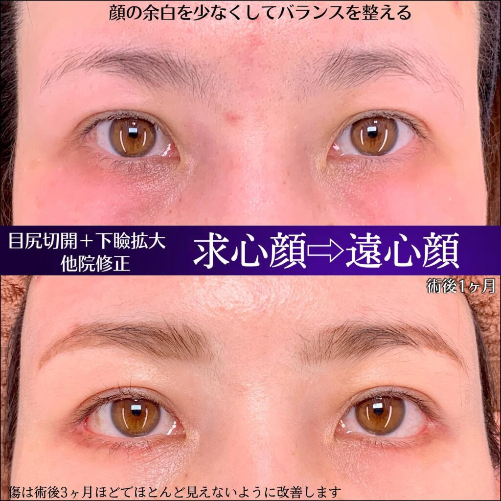 目尻切開と下瞼拡大と他院修正の症例写真