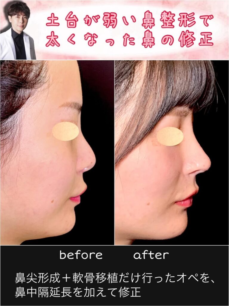 鼻尖形成と軟骨移植と鼻中隔延長の症例写真 (3)