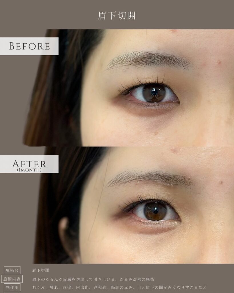 眉下切開の症例写真 (3)