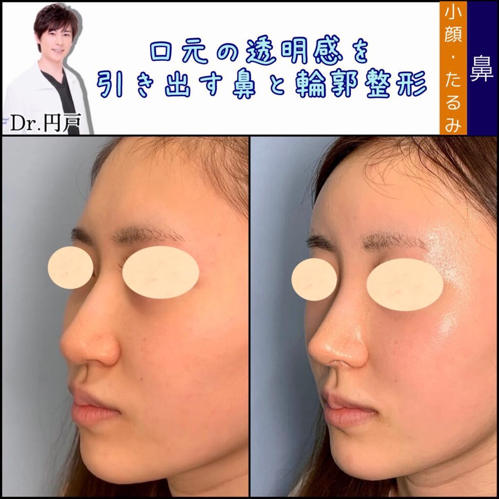 鼻尖形成と軟骨移植と鼻中隔延長と小鼻縮小と脂肪輪郭形成の症例写真