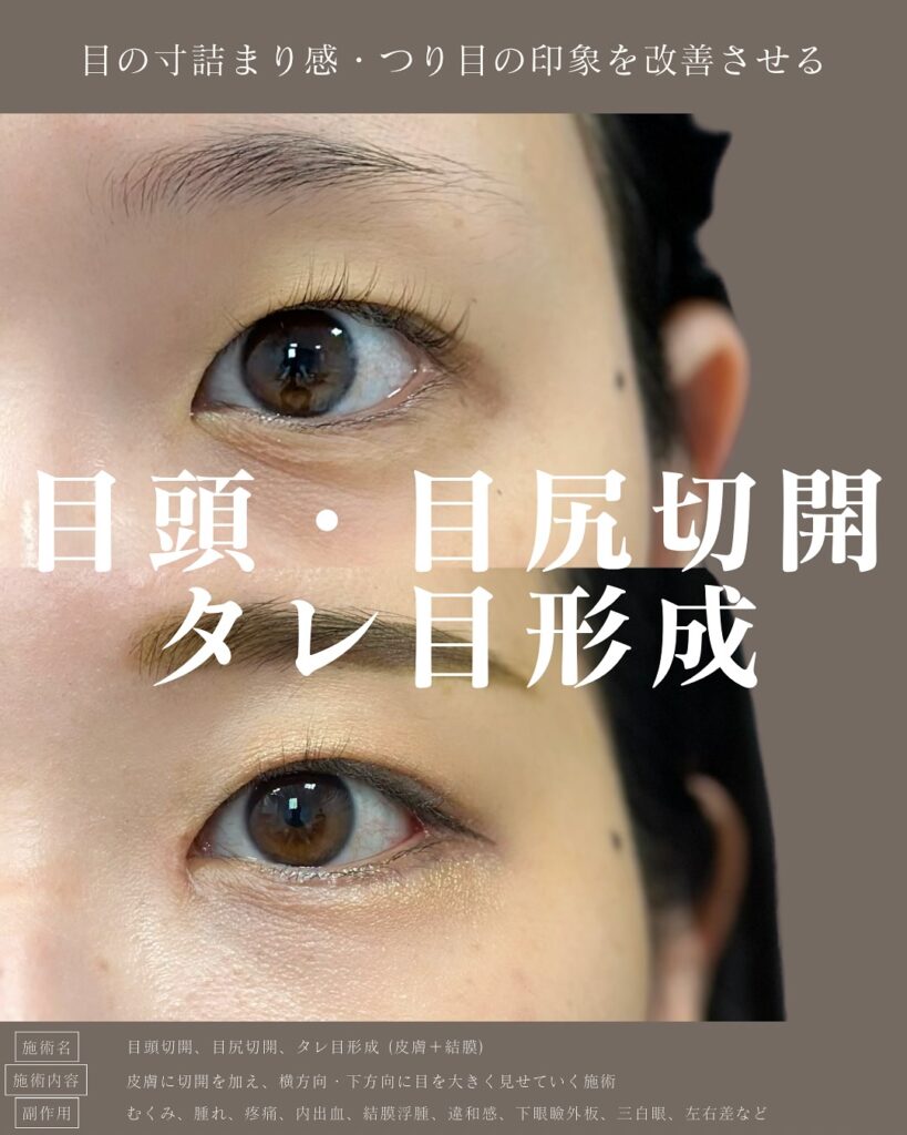 目頭切開と目尻切開とタレ目形成の症例写真 (1)
