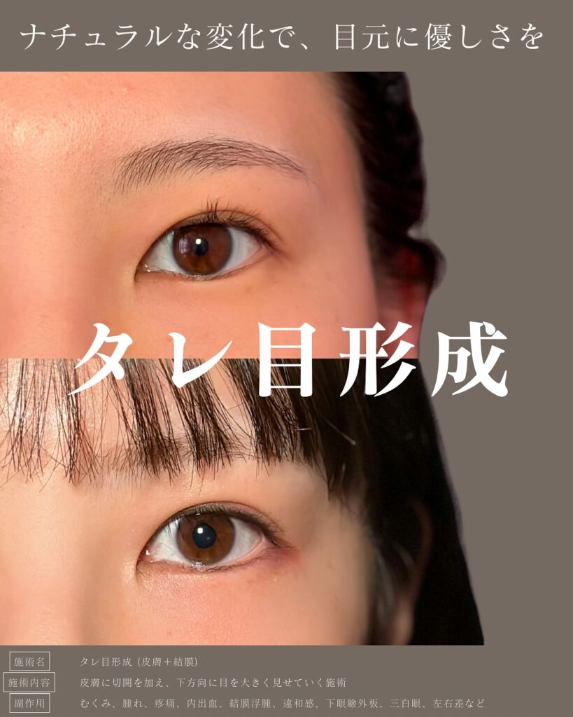 タレ目形成の症例写真 (11)