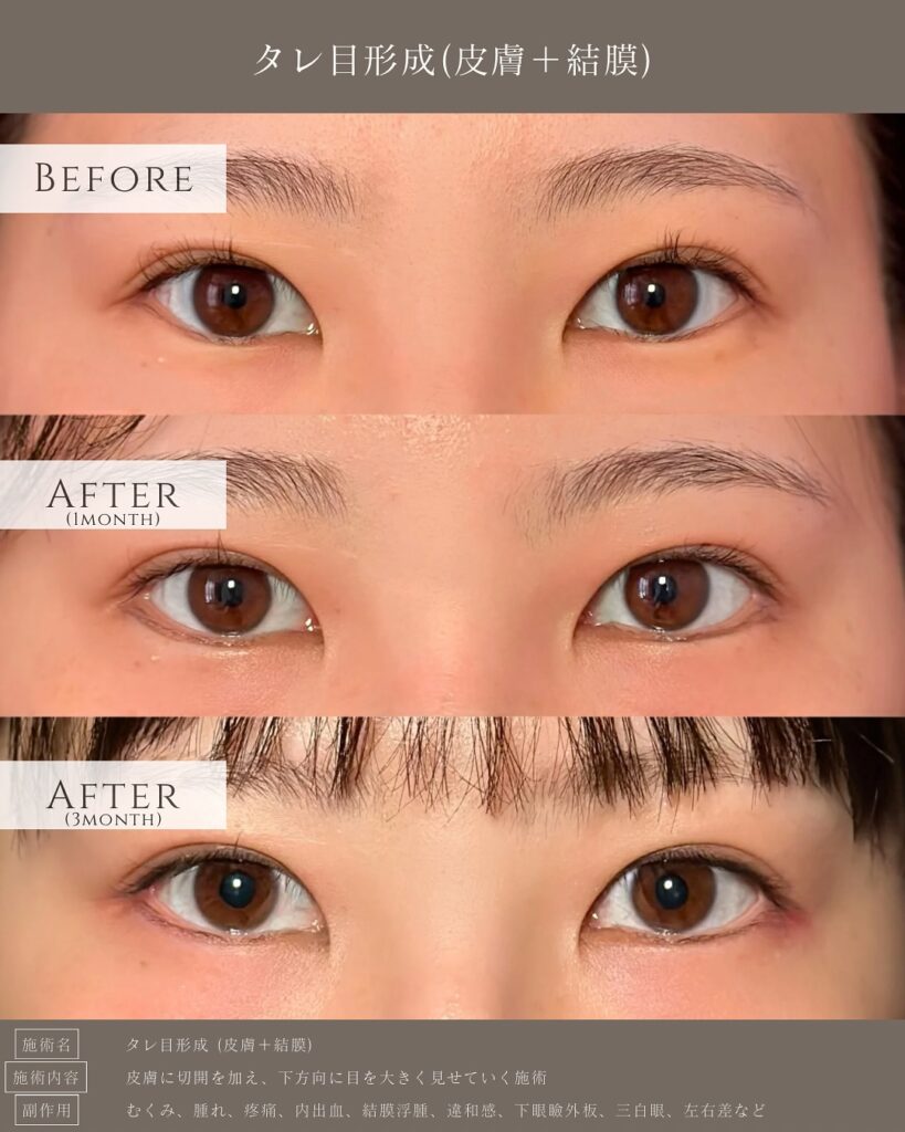 タレ目形成の症例写真 (12)