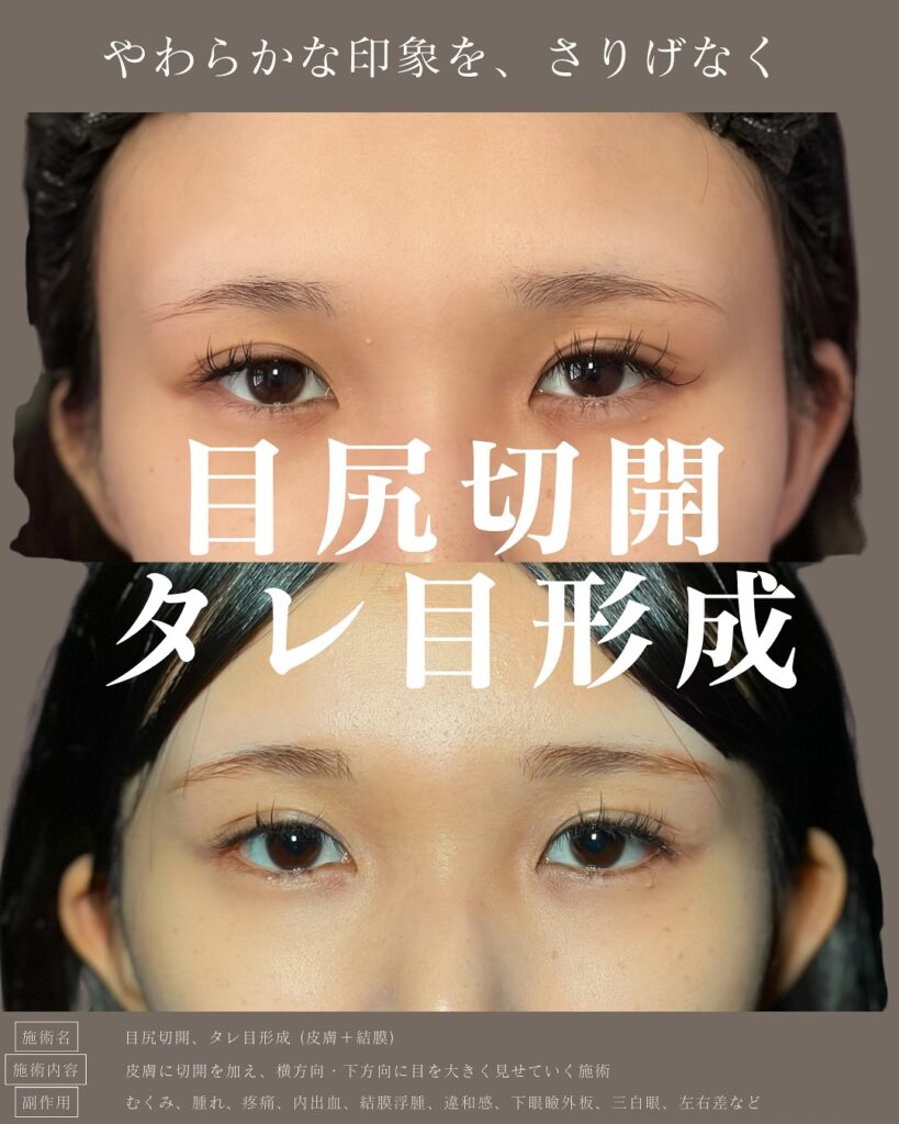 目尻切開とタレ目形成の症例写真 (1)