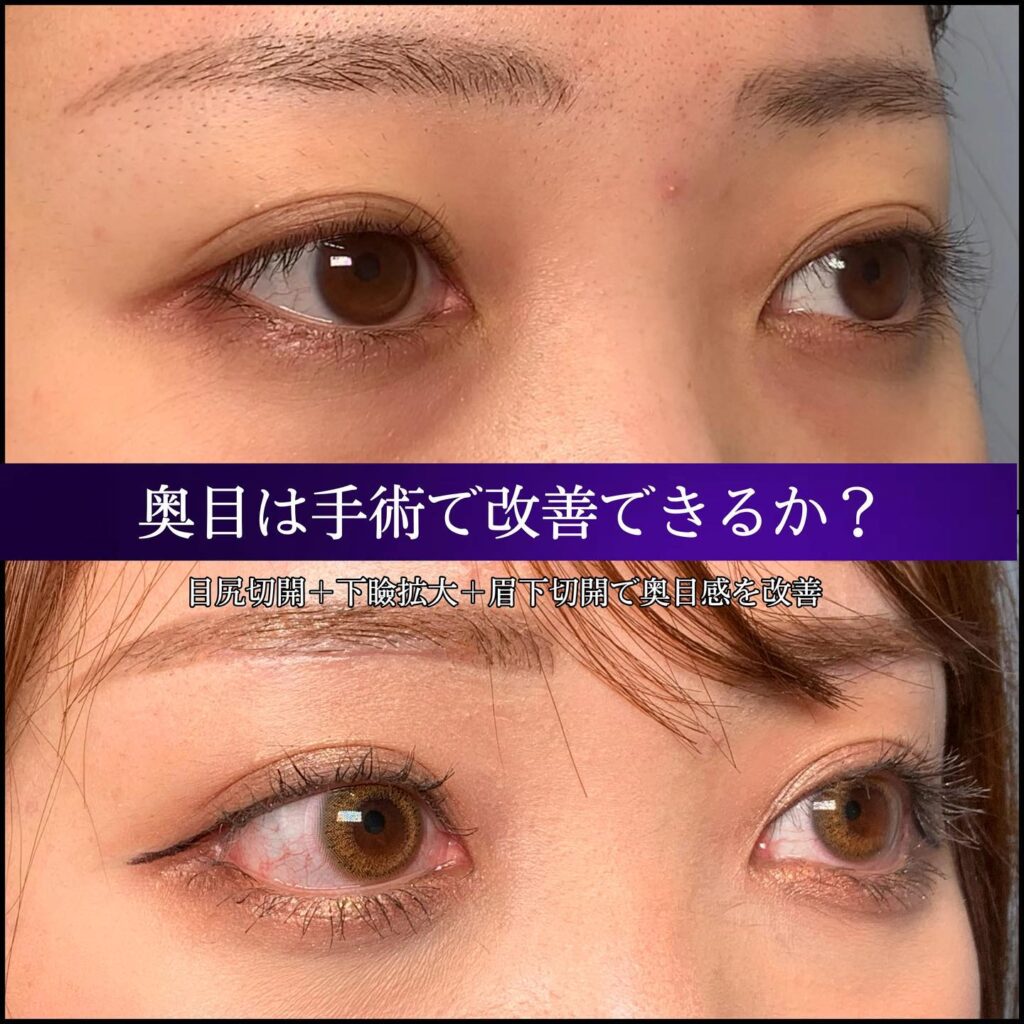 目尻切開と下瞼拡大と目尻切開の症例写真 (2)