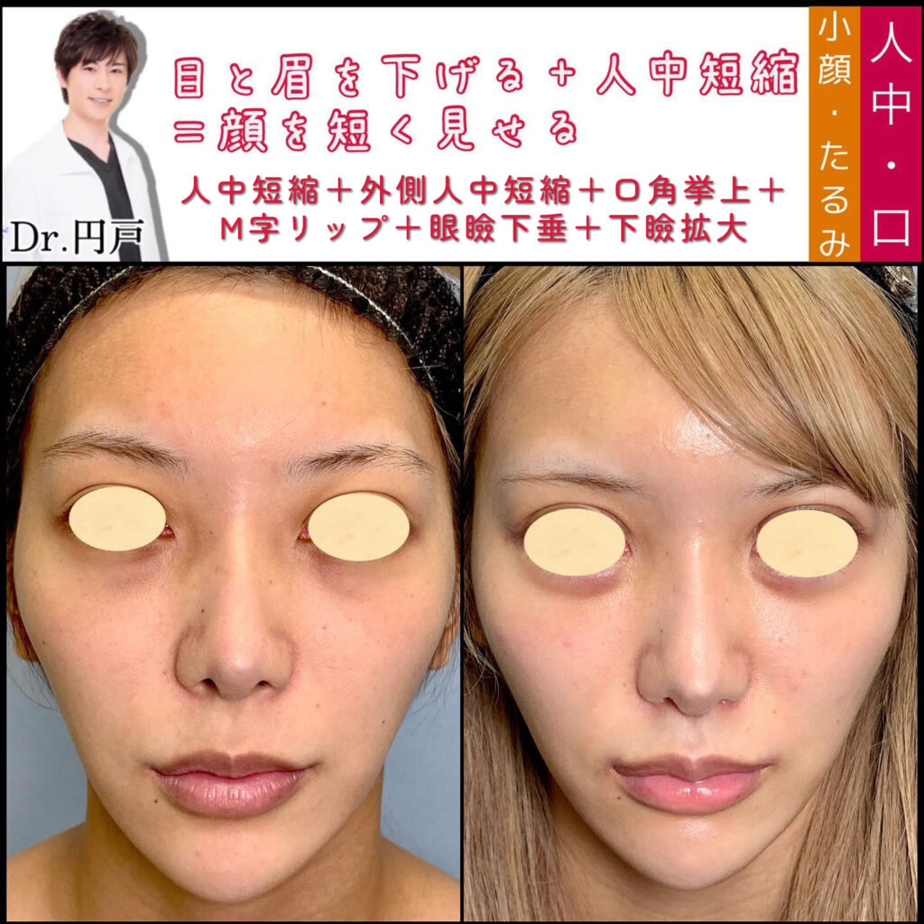 人中短縮と外側人中短縮と口角挙上とM字リップと眼瞼下垂と下瞼拡大を同時に行った症例写真