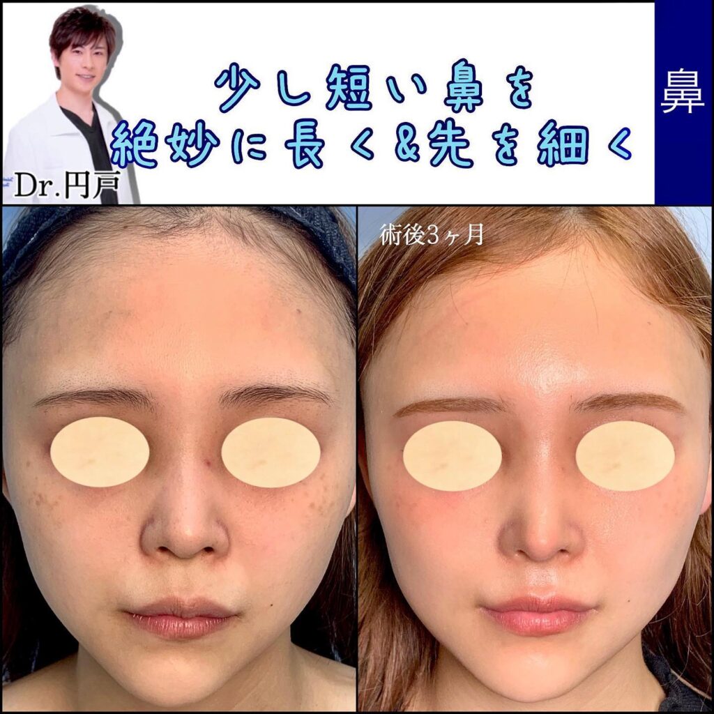 鼻尖形成で少し短い鼻を微妙に長くした症例写真 (2)