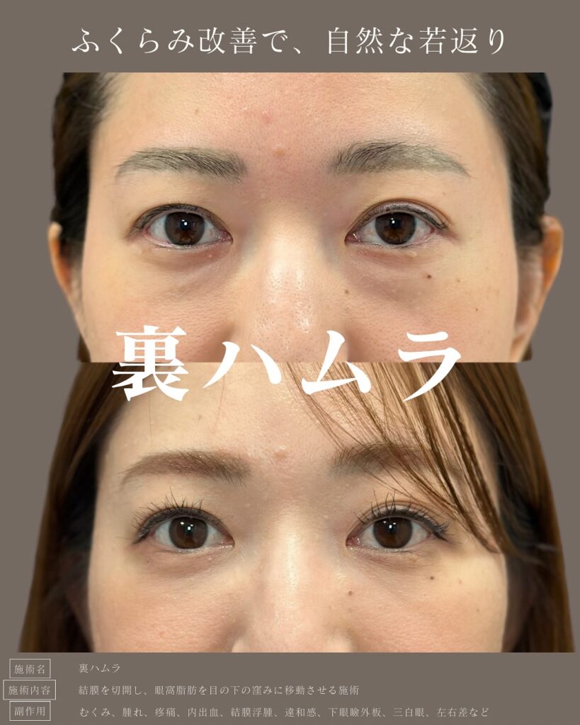 裏ハムラ法の症例写真 (14)