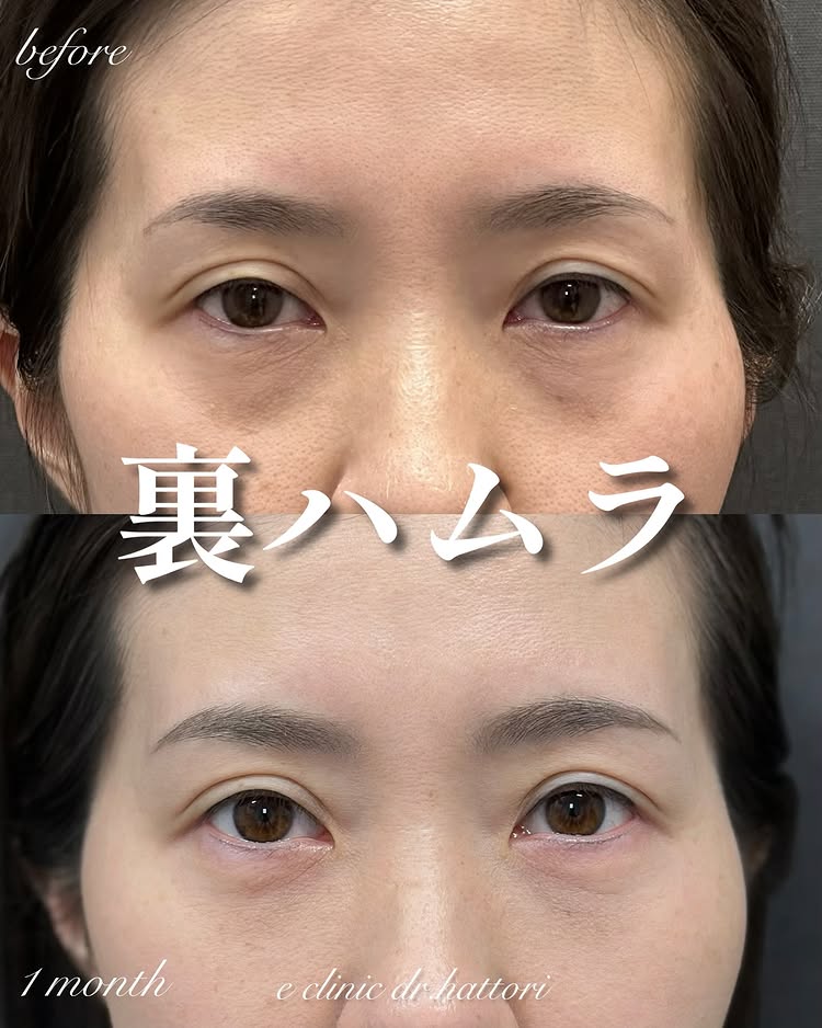 裏ハムラ法の症例写真 (65)