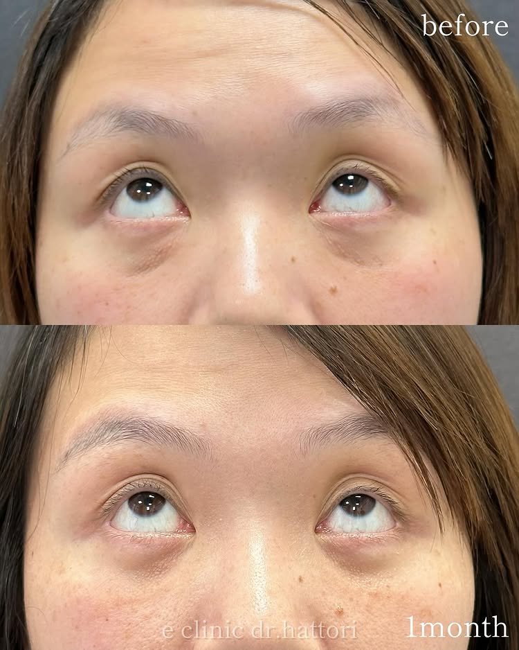 裏ハムラ法の症例写真 (69)