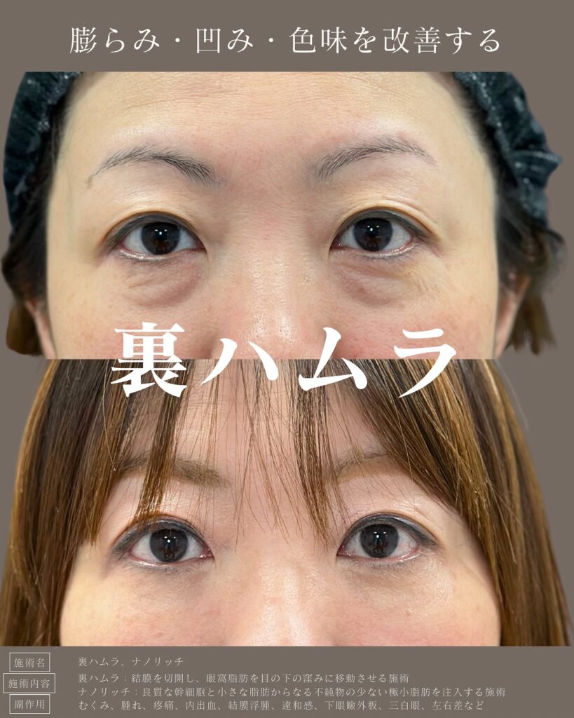 裏ハムラ法とナノリッチの症例写真 (15)