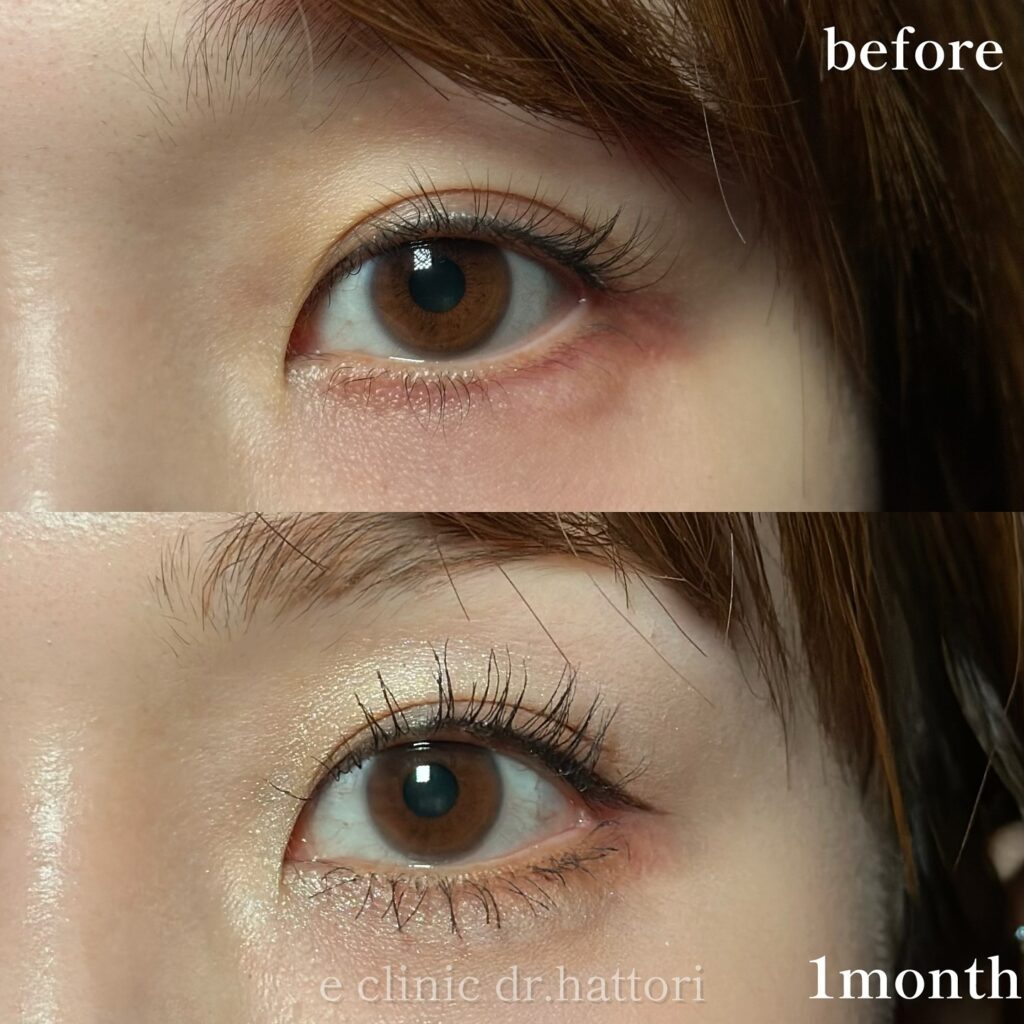 目尻切開とタレ目形成の症例写真 (52)