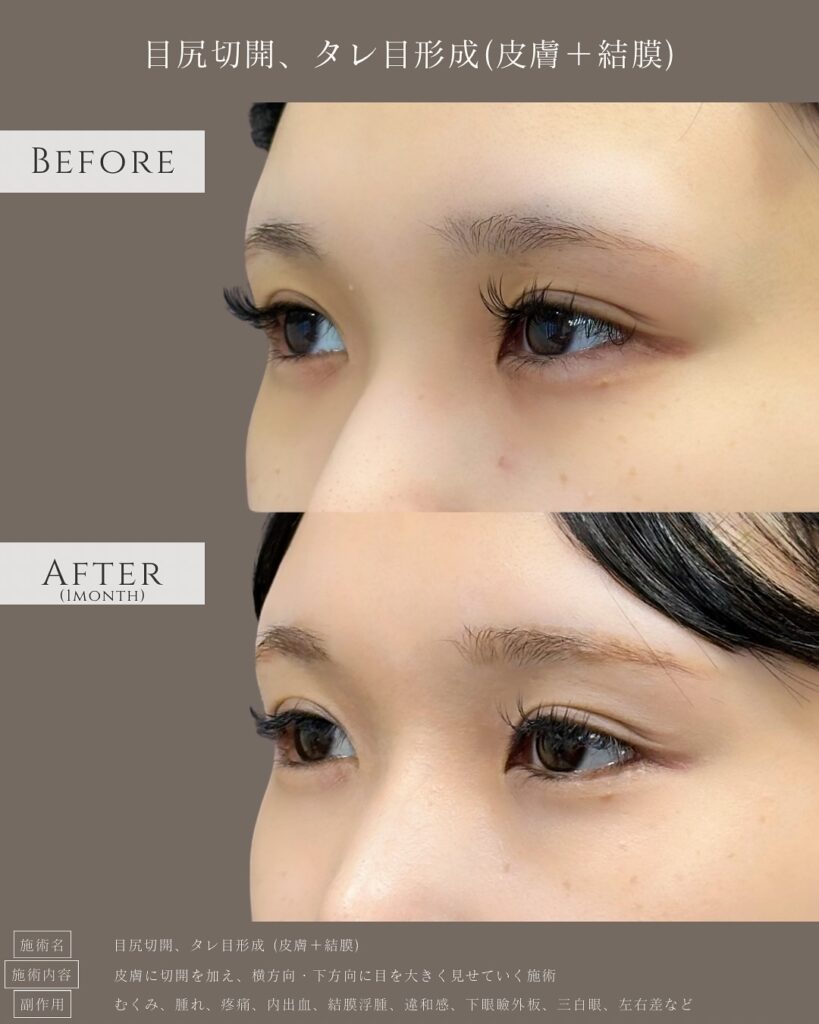 目尻切開とタレ目形成の症例写真 (3)