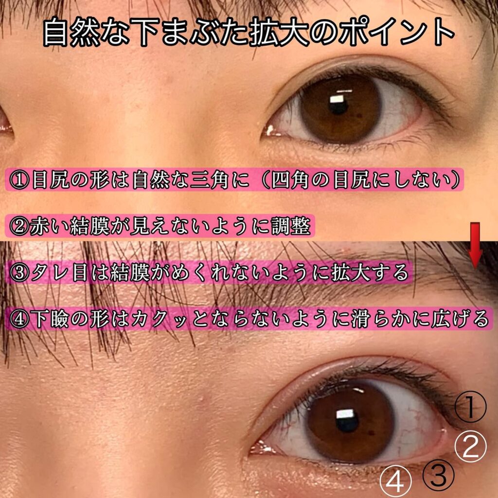 グラマラスライン形成と全切開と眼瞼下垂と目頭切開と目尻切開の症例写真