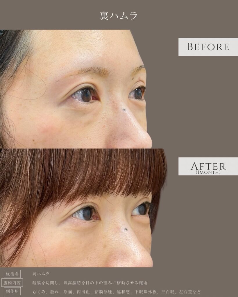 裏ハムラ法の症例写真 (45)