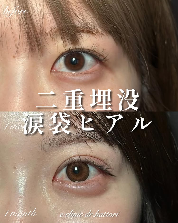 埋没法と涙袋のヒアルロン酸の症例写真 (3)