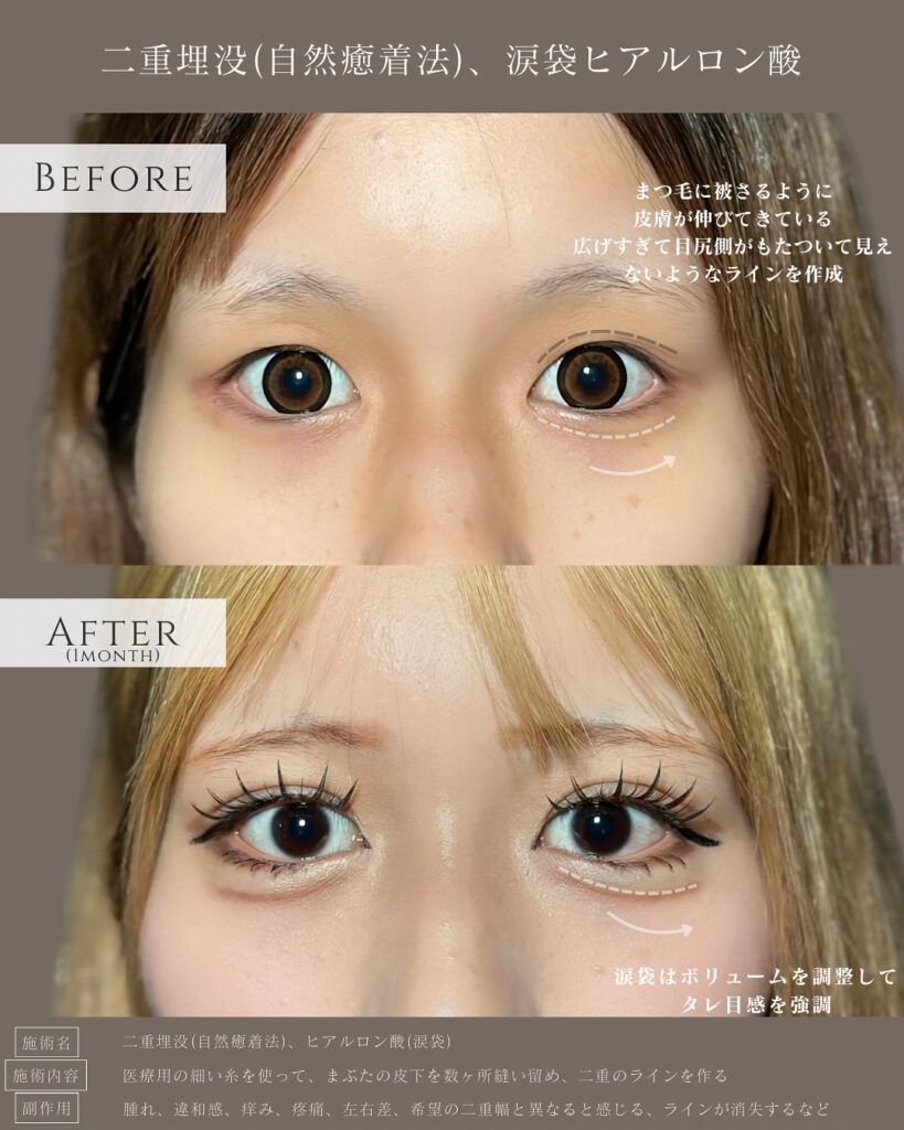 自然癒着法と涙袋のヒアルロン酸の症例写真 (8)