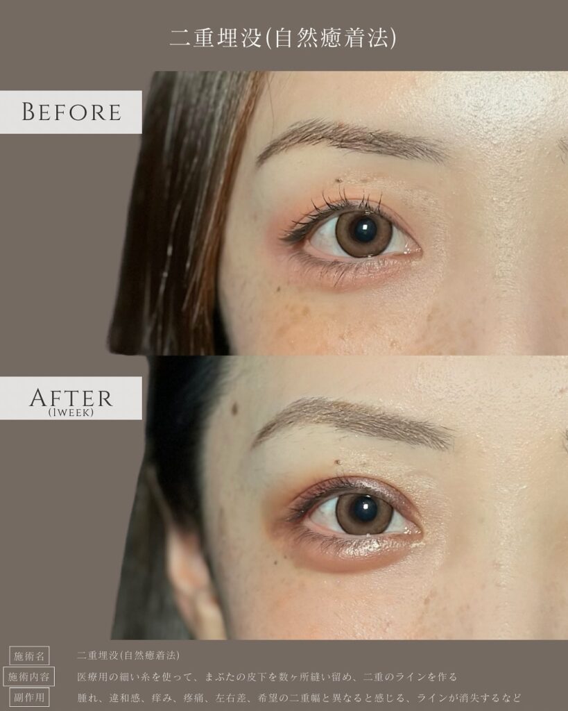 自然癒着法の症例写真 (7)