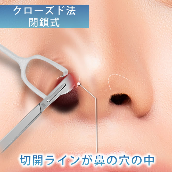 閉鎖式とクローズド法の鼻中隔延長の切開ラインの図解