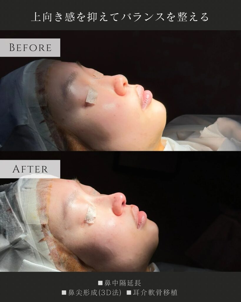 鼻中隔延長と鼻尖形成と耳介軟骨移植の症例写真 (2)