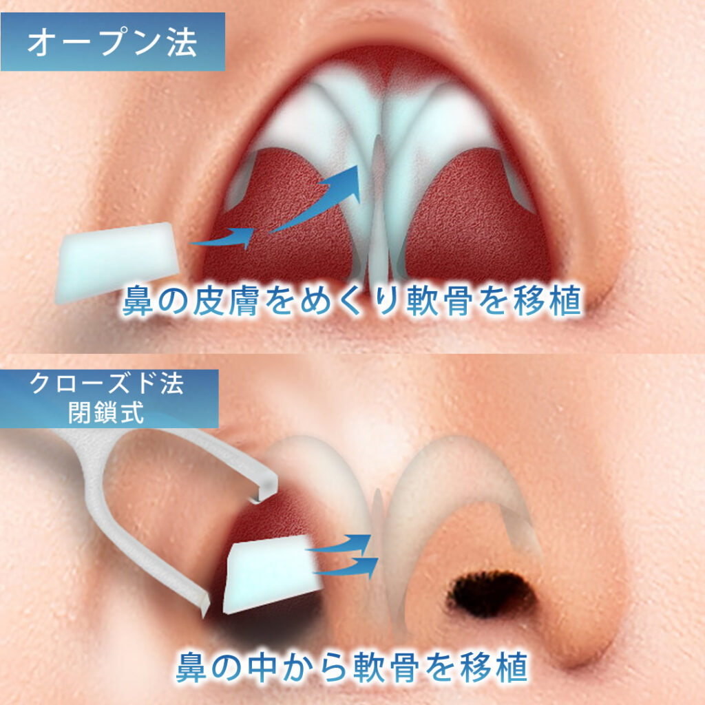 オープン法とクローズド法と閉鎖式の軟骨移植の比較
