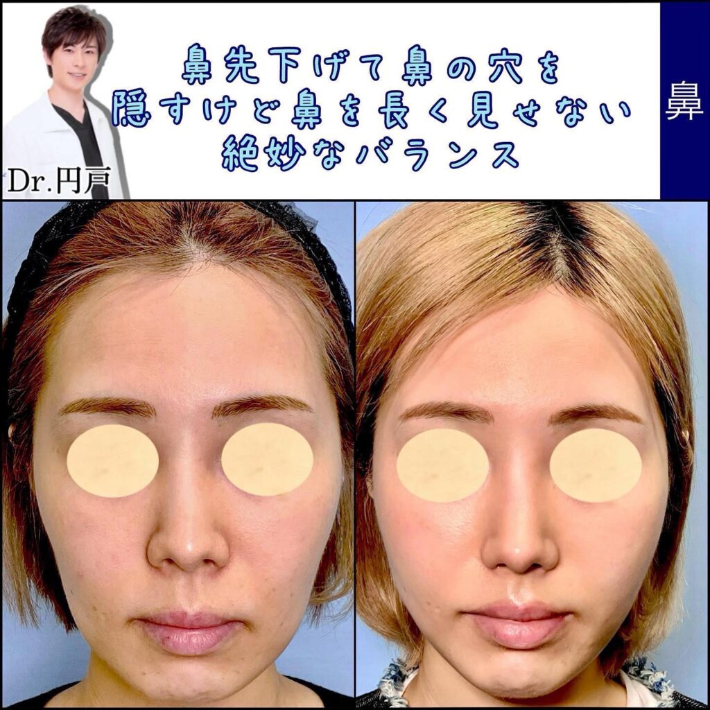 鼻尖形成と軟骨移植と鼻中隔延長と鼻柱下降の症例写真 (6)