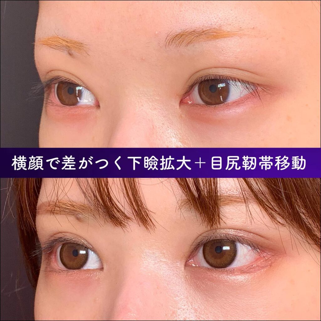 目尻切開とグラマラス形成の症例写真 (2)