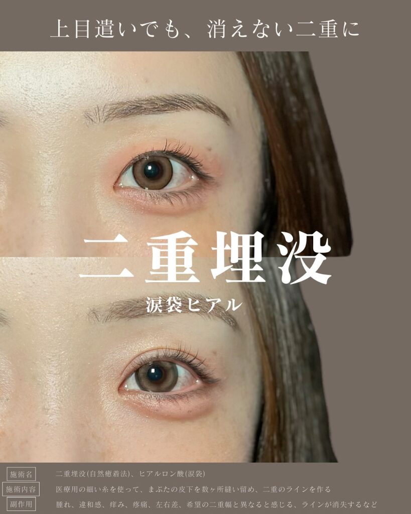 自然癒着法と涙袋のヒアルロン酸の症例写真 (1)