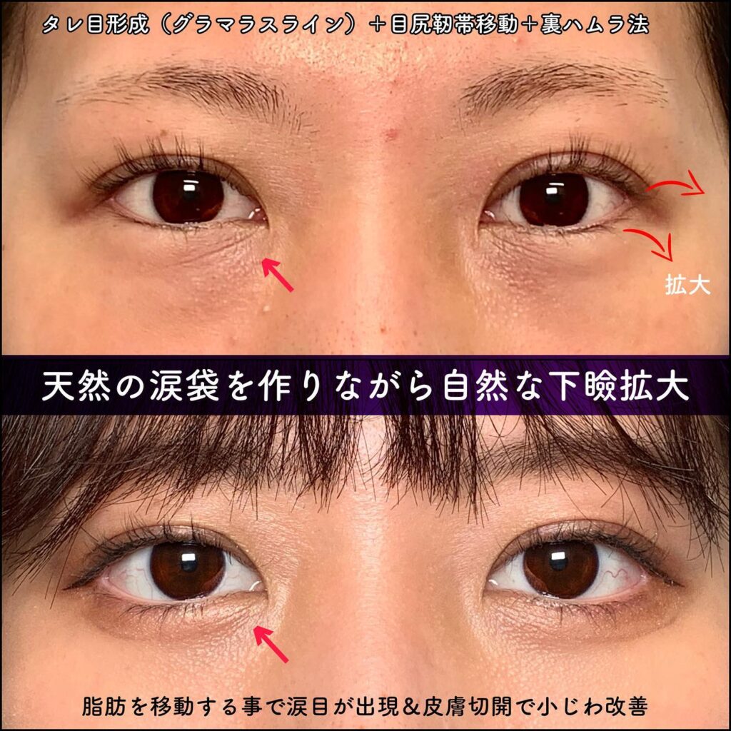 タレ目形成と目尻靭帯移動と裏ハムラ法の症例写真 (2)