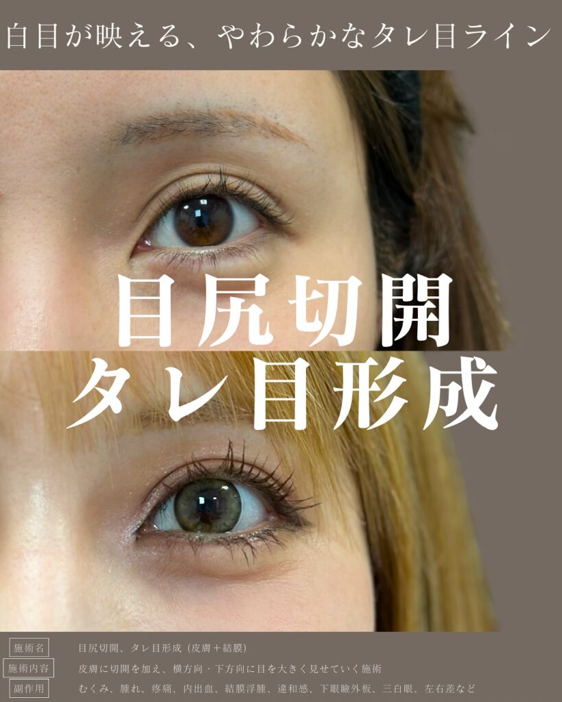 目尻切開とタレ目形成の症例写真 (30)