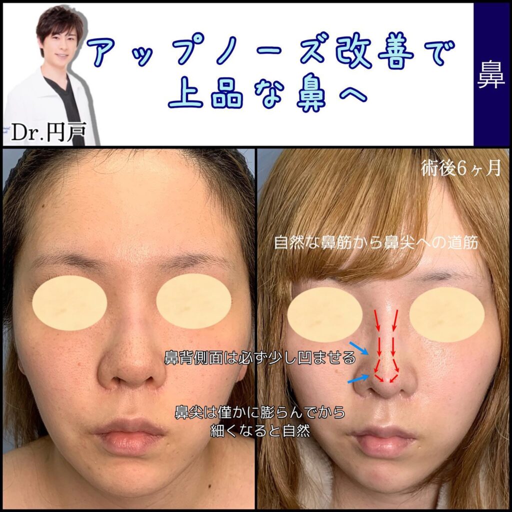 鼻中隔延長の症例写真 (4)