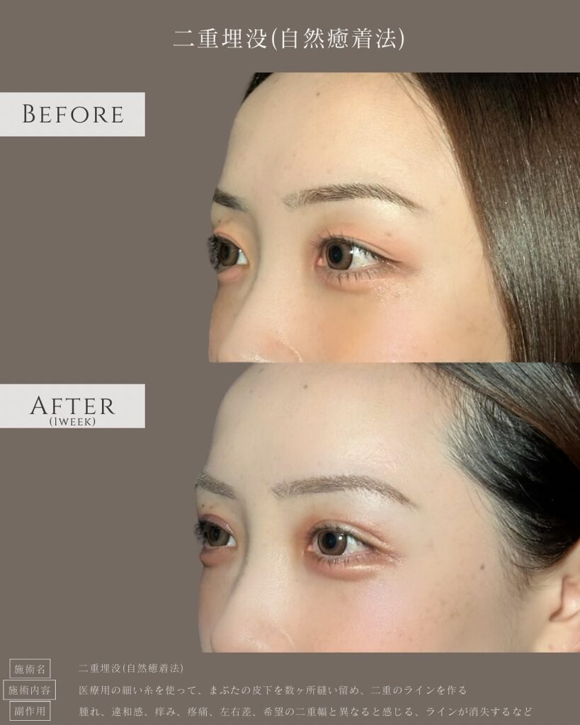 自然癒着法の症例写真 (6)