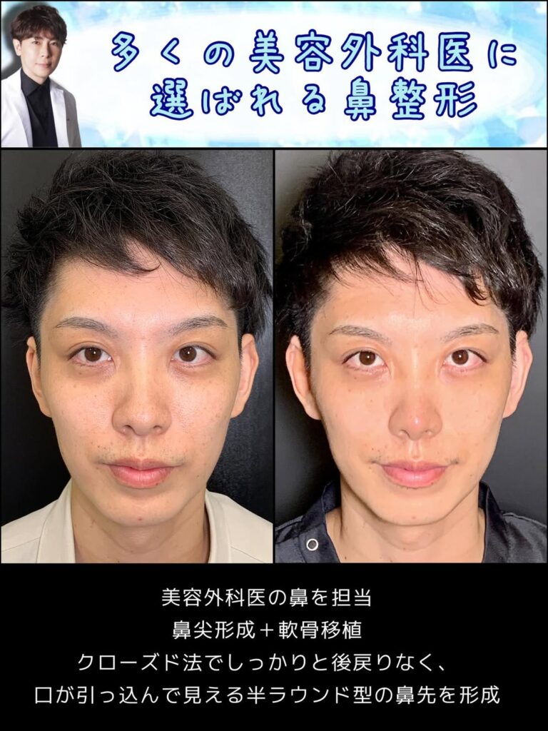 鼻尖形成と軟骨移植の症例写真 (1)