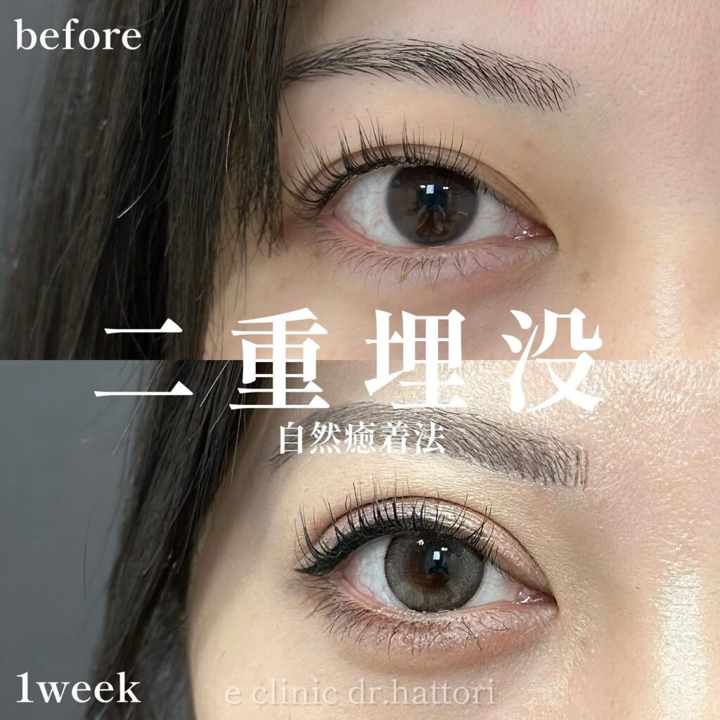 自然癒着法の症例写真 (18)