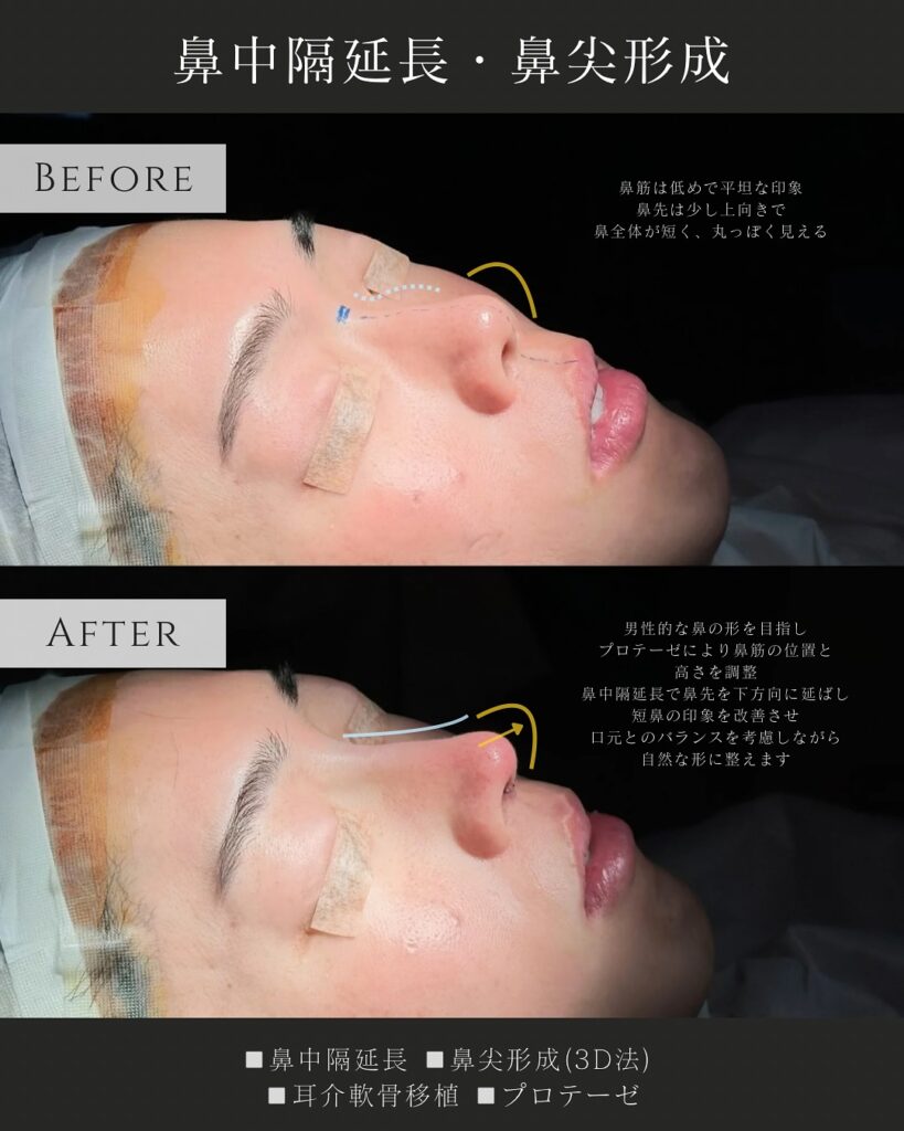 鼻中隔延長と鼻尖形成と耳介軟骨磯久とプロテーゼの症例写真 (1)
