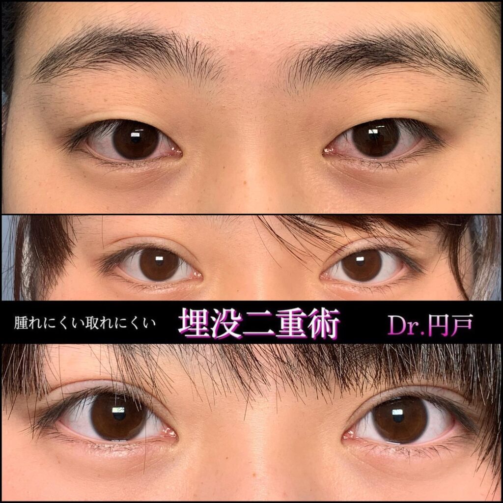 埋没法の症例写真 (17)