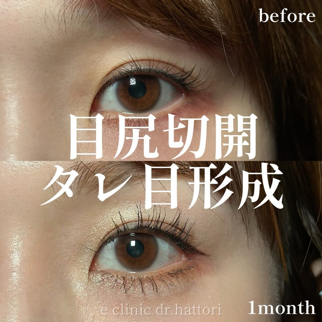 目尻切開とタレ目形成の症例写真 (50)