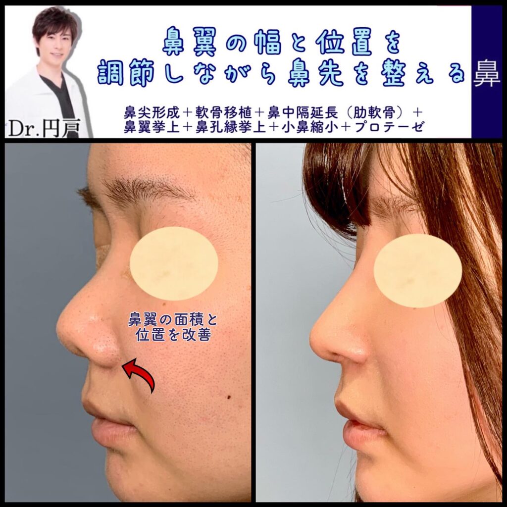 鼻尖形成と軟骨移植と鼻中隔延長と鼻翼挙上と鼻孔縁挙上と小鼻縮小とプロテーゼの症例写真 (4)